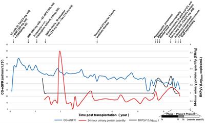 Case Report: Malacoplakia Due to E. coli With Cryptococcus albidus Infection of a Transplanted Kidney in a Patient With Recurrent Urinary Tract Infection